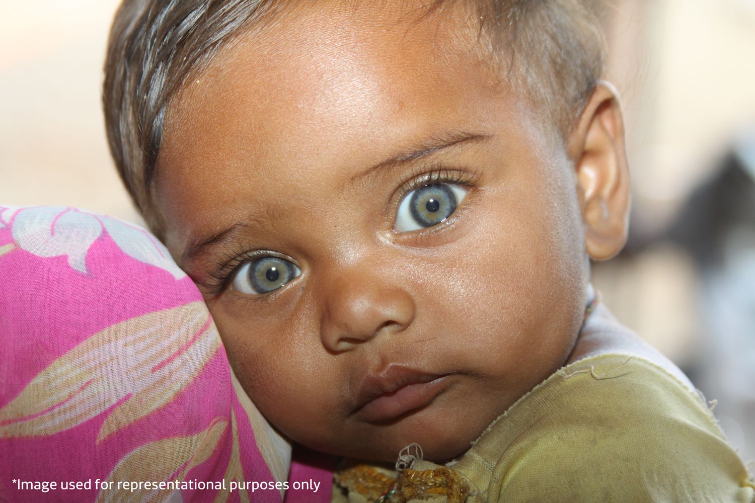 malnourished children in India